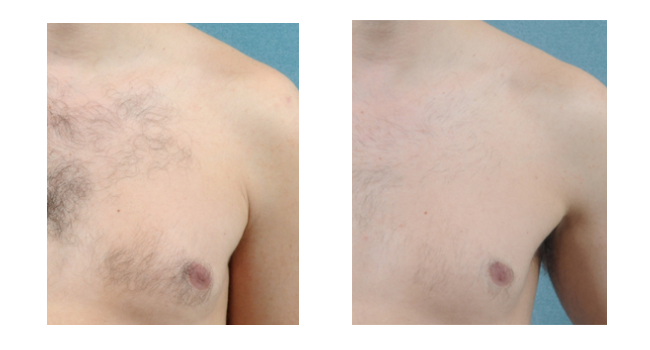 Hinsdale Laser Hair Removal For Men | Laser Aesthetic Center