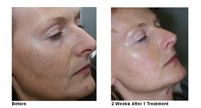 Guide to Professional Brown Spot Removal Treatment Options
