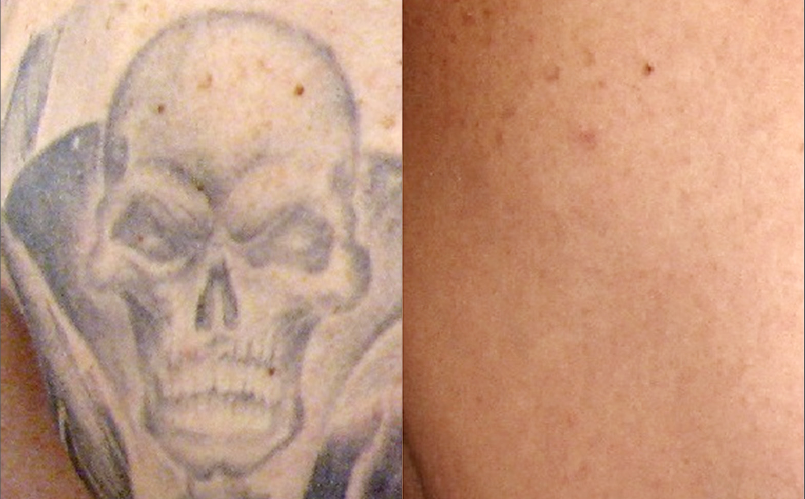 Tattoo Removal Worth It Wheaton Laser Tattoo Removal