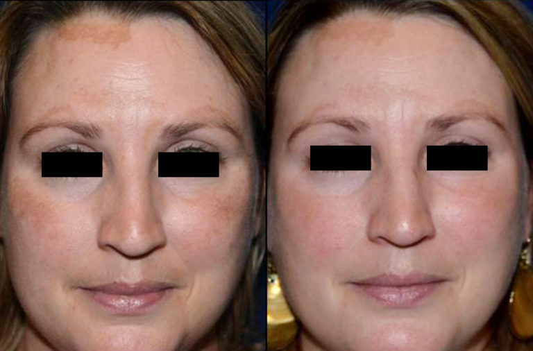 Find Melasma Treatment that Actually Works Laser Aesthetic Center