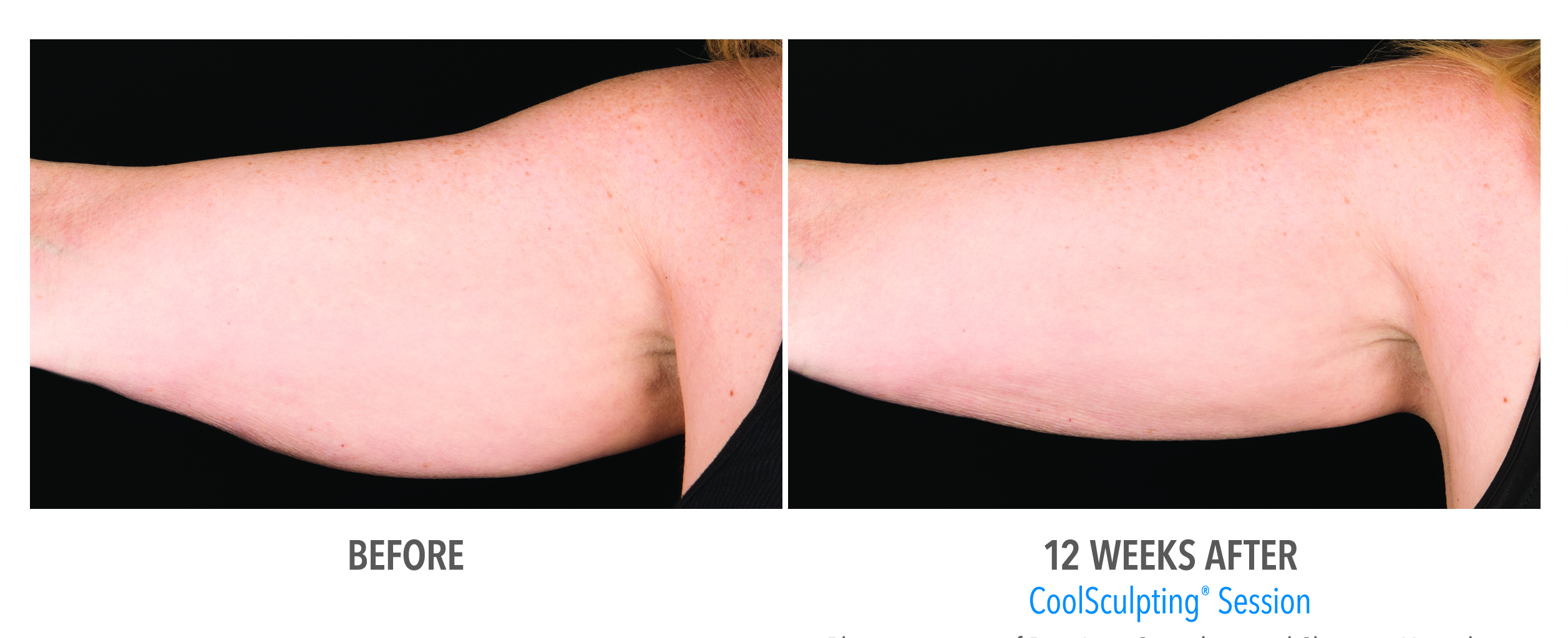 Armpit fat underarm wrinkled skin, Saggy skin removal. woman body