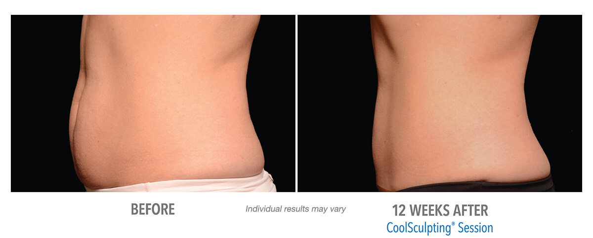 Laser Aesthetic Center - Hinsdale CoolSculpting & Body Contouring